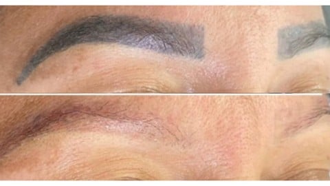 Brow tattoo removal course