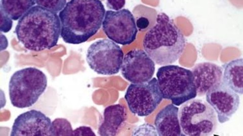 Megaloblastic Anemia : Intro, Clinical Features & Management