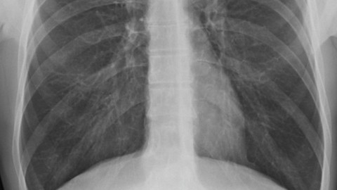 CASE HISTORY  Young patient with Chest pain & breathlessness