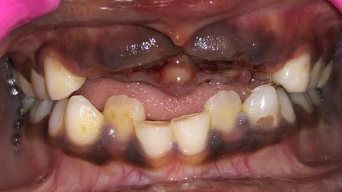 Dental Avulsion: Emergency Management and Clinical Care