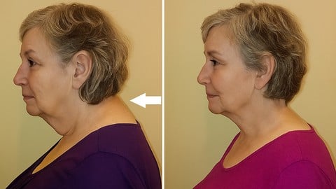 Neck Hump | Get Rid of the Fat at the Top of Your Back