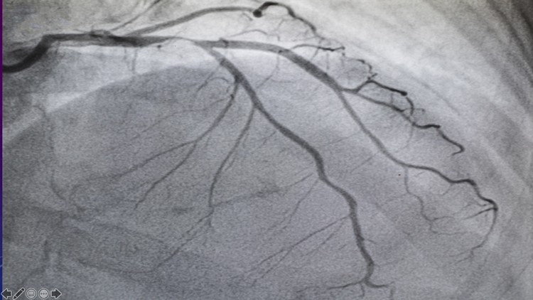 Master Coronary Angiograms with Cardiac anatomy & Video Quiz