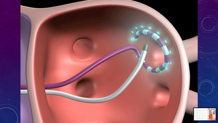 Master Cardiac Electrophysiology & Rhythm Management - 2