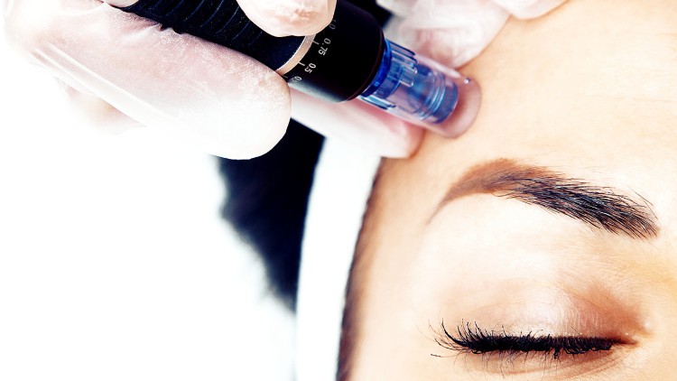 Micro-needling facial treatment