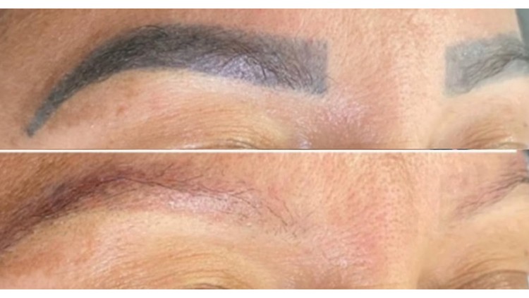 Brow tattoo removal course
