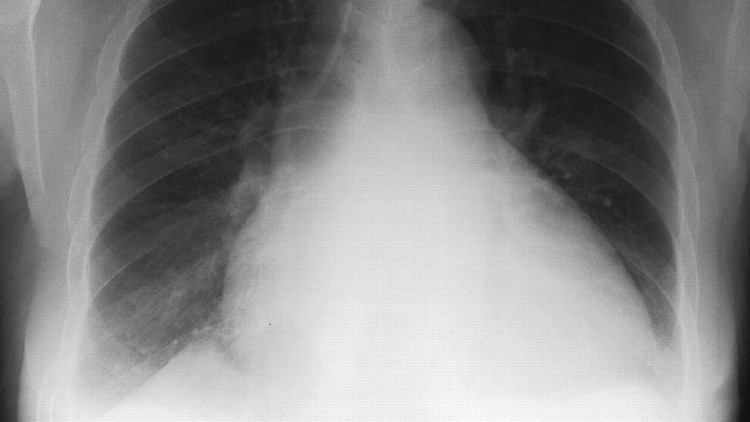 Congestive Cardiac Failure : A Case based Discussion