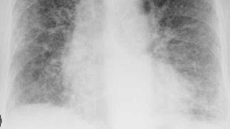 Pulmonary Fibrosis : A case Based Discussion